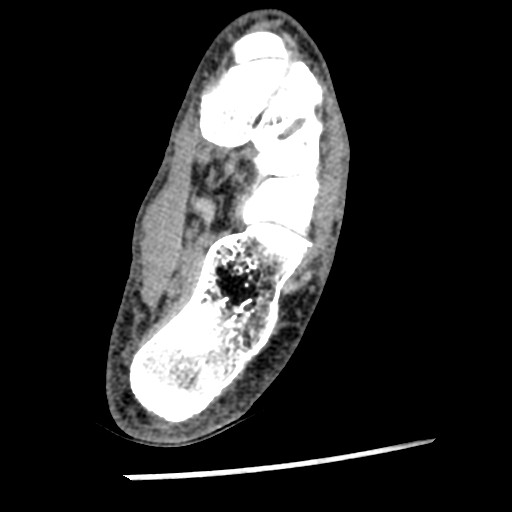 Anterior tibial artery false aneurysm (Radiopaedia 88984-105809 A 191).jpg