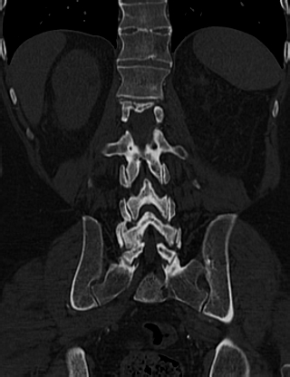 Anterior vertebral scalloping (abdominal aortic aneurysm) (Radiopaedia 66744-76067 Coronal bone window 51).jpg