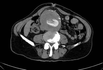 Anterior vertebral scalloping (abdominal aortic aneurysm) (Radiopaedia 66744-76067 F 54).jpg