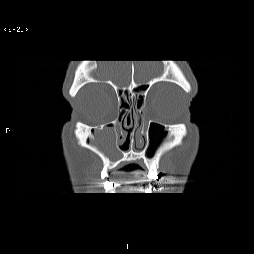 File:Antrochoanal Polyp (Radiopaedia 70510-80631 Coronal bone window 11).jpg