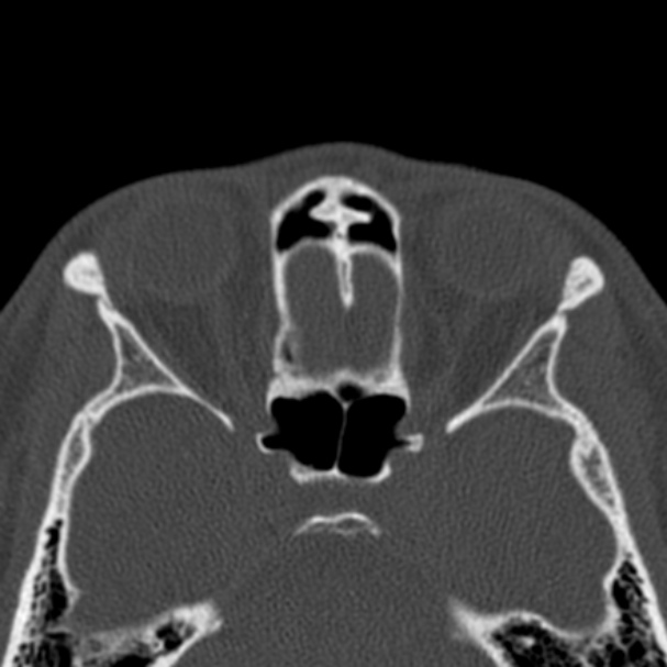 Antrochoanal polyp (Radiopaedia 33984-35202 Axial bone window 58).jpg