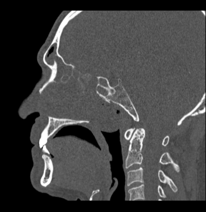 Antrochoanal polyp (Radiopaedia 79011-92169 Sagittal bone window 26).jpg