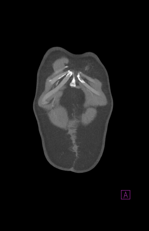 Aortectomy and axillary-bifemoral bypass (Radiopaedia 28303-28545 C 8).jpg