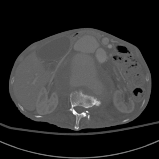 Aortic aneurysm with spinal destruction (Radiopaedia 42301-45410 Axial bone window 35).jpg