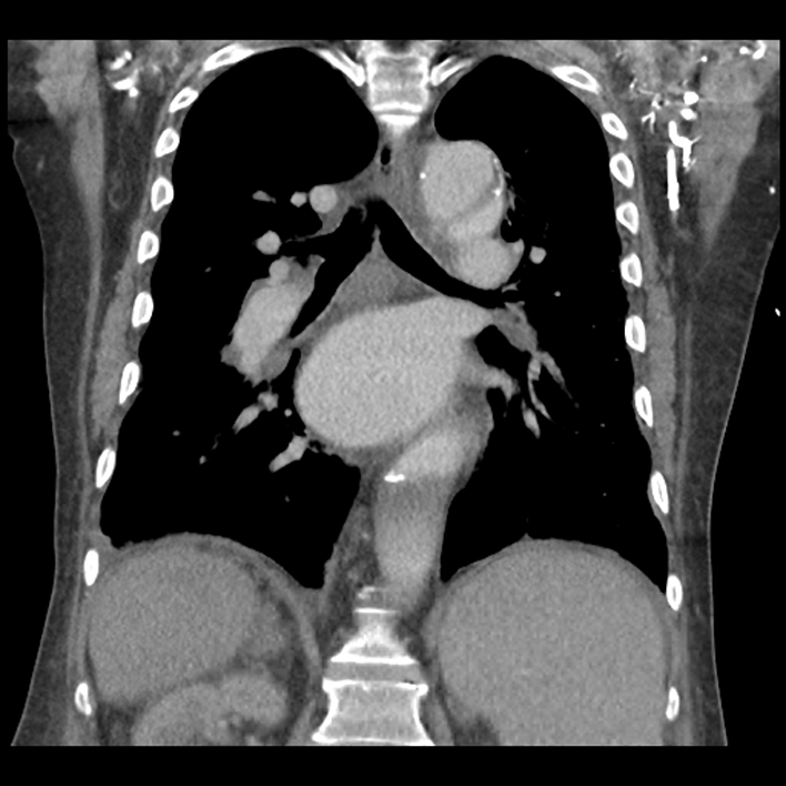 Aortic arch graft infection (FDG PET-CT) (Radiopaedia 71975-82437 Coronal 39).jpg