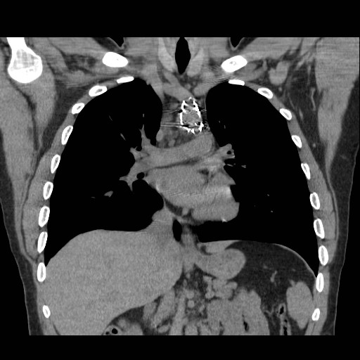 File:Aortic arch stent (Radiopaedia 30030-30595 Coronal non-contrast 10).jpg