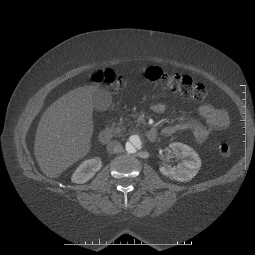 File:Aortic dissection- Stanford A (Radiopaedia 35729-37268 C 1).jpg