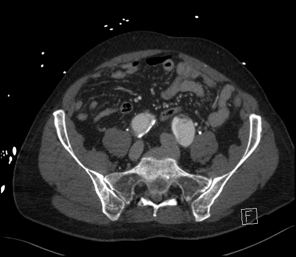 Aortic dissection (CTPA) (Radiopaedia 75506-86750 E 109).jpg