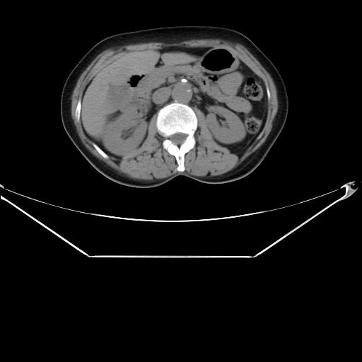 File:Aortic dissection (Radiopaedia 25350-25604 B 47).jpg