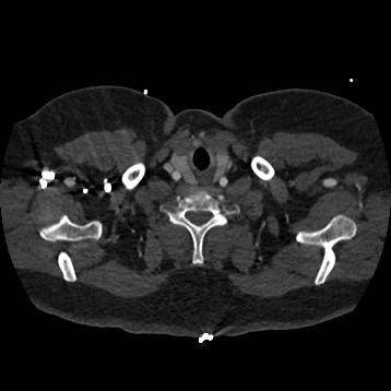 Aortic dissection (Radiopaedia 57969-64959 A 10).jpg