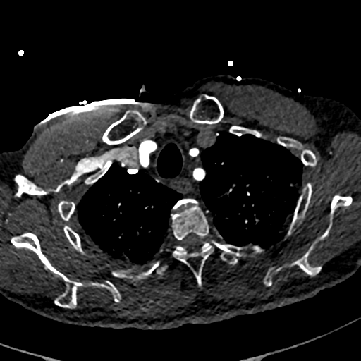 File:Aortic dissection - DeBakey type II (Radiopaedia 64302-73082 A 16).png