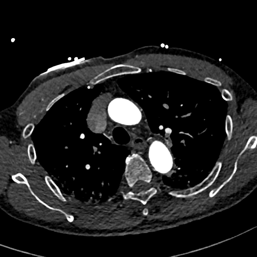 File:Aortic dissection - DeBakey type II (Radiopaedia 64302-73082 A 28).png