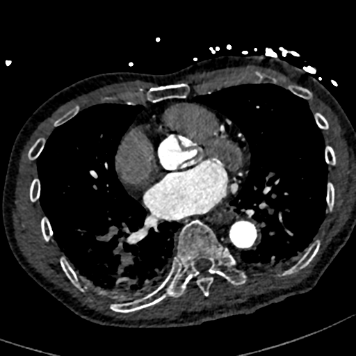 File:Aortic dissection - DeBakey type II (Radiopaedia 64302-73082 A 55).png