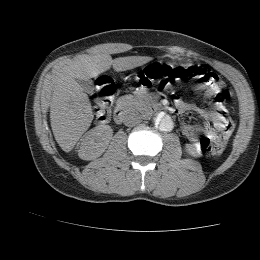 File:Aortic dissection - Stanford A -DeBakey I (Radiopaedia 28339-28587 B 135).jpg
