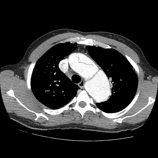 File:Aortic dissection - Stanford A -DeBakey I (Radiopaedia 28339-28587 B 14).jpg