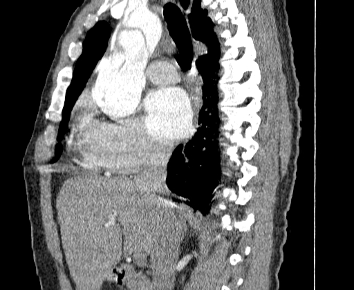 Aortic dissection - Stanford A -DeBakey I (Radiopaedia 28339-28587 C 14).jpg