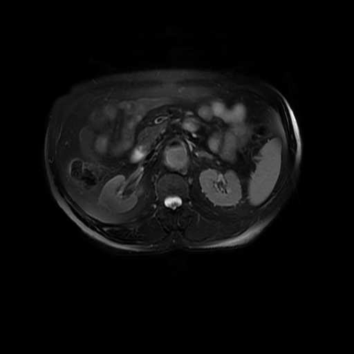 File:Aortic dissection - Stanford A - DeBakey I (Radiopaedia 23469-23551 Axial T2 fat sat 24).jpg