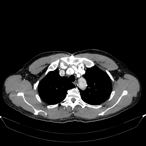 Aortic dissection - Stanford type A (Radiopaedia 83418-98500 A 14).jpg