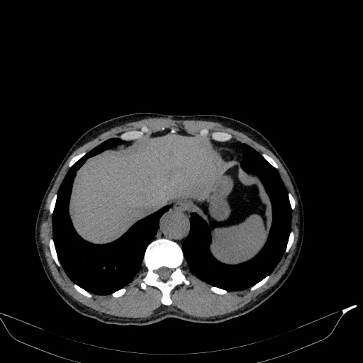 Aortic dissection - Stanford type A (Radiopaedia 83418-98500 Axial non-contrast 38).jpg