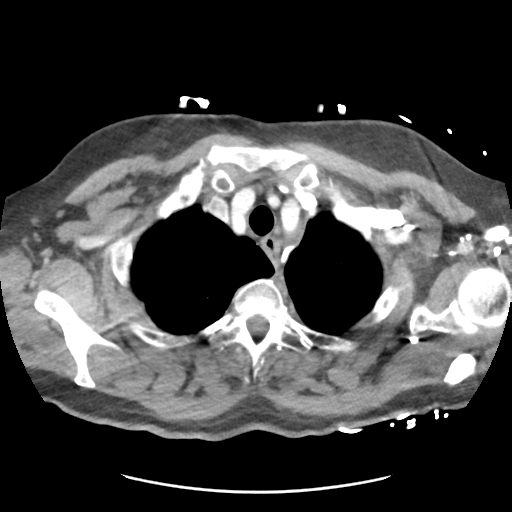 File:Aortic dissection - Stanford type B (Radiopaedia 50171-55512 A 8).png