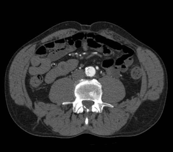 Aortic dissection - Stanford type B (Radiopaedia 73648-84437 A 184).jpg
