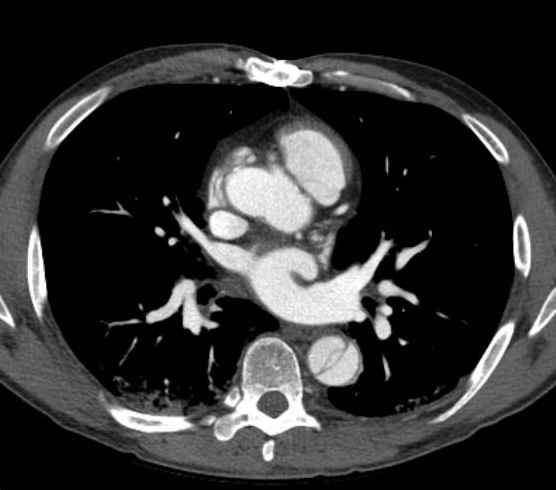 File:Aortic dissection - Stanford type B (Radiopaedia 73648-84437 A 57).jpg