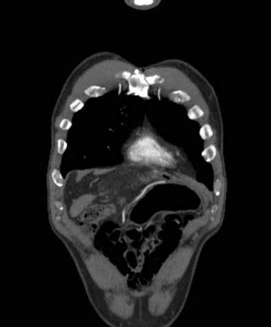 Aortic dissection - Stanford type B (Radiopaedia 73648-84437 B 17).jpg