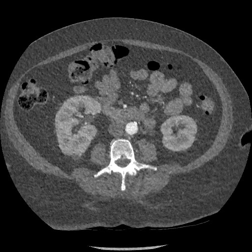 File:Aortic dissection - Stanford type B (Radiopaedia 88281-104910 A 123).jpg