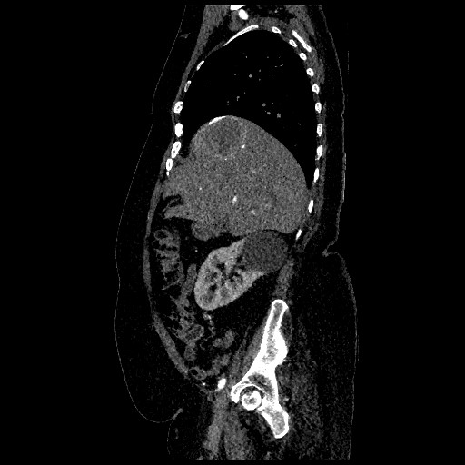 Aortic dissection - Stanford type B (Radiopaedia 88281-104910 C 21).jpg