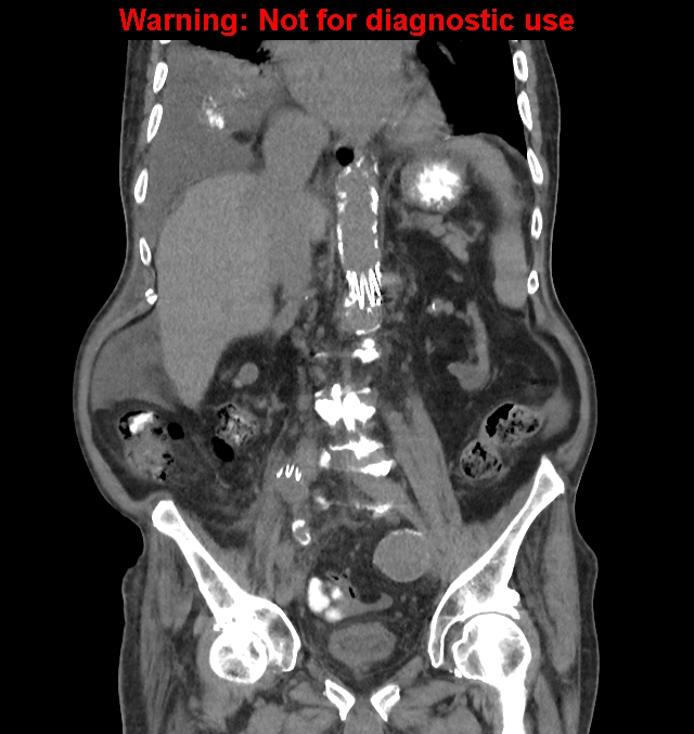 Aortic graft infection (Radiopaedia 44979-48907 non-contrast 28).jpg