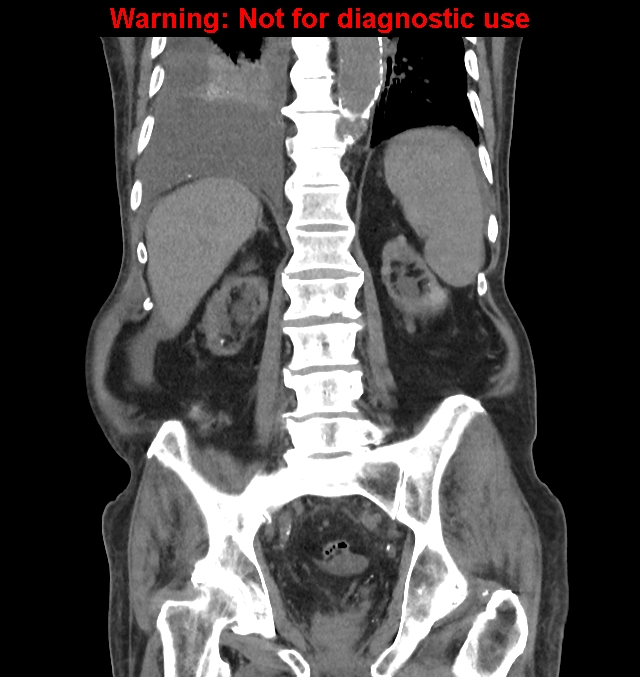 Aortic graft infection (Radiopaedia 44979-48907 non-contrast 35).jpg