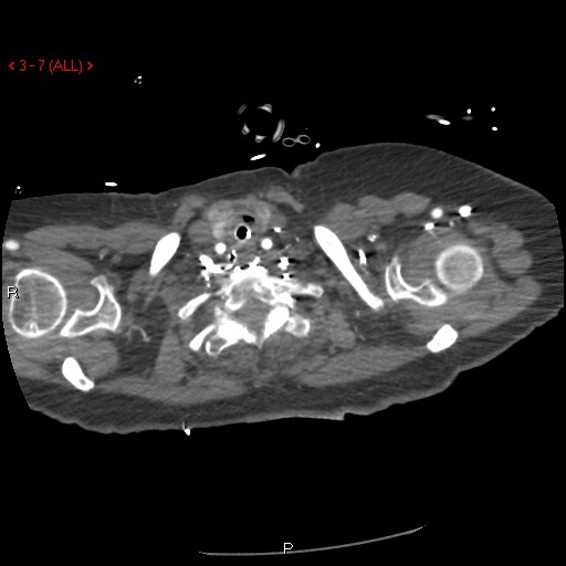Aortic intramural hematoma (Radiopaedia 27746-28001 A 7).jpg