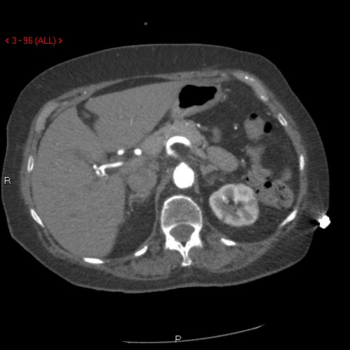 Aortic intramural hematoma (Radiopaedia 27746-28001 A 96).jpg