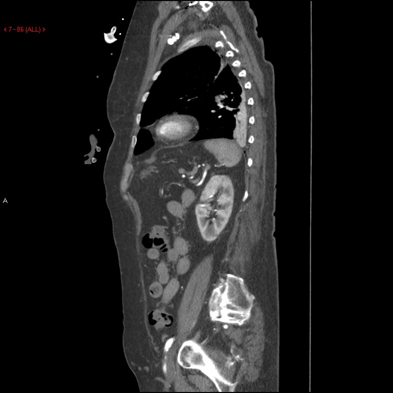 Aortic intramural hematoma (Radiopaedia 27746-28001 C 55).jpg