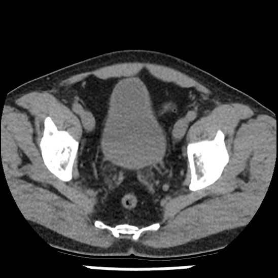 Aortic intramural hematoma (type B) (Radiopaedia 79323-92387 Axial non-contrast 105).jpg
