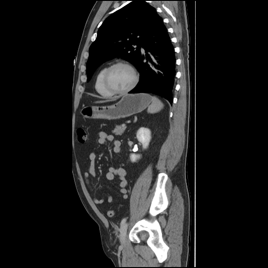 Aortic intramural hematoma (type B) (Radiopaedia 79323-92387 Sagittal C+ delayed 38).jpg