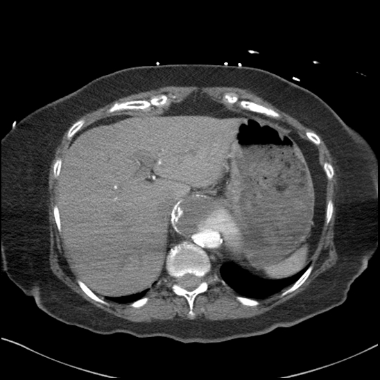 Aortic intramural hematoma with dissection and intramural blood pool (Radiopaedia 77373-89491 B 98).jpg