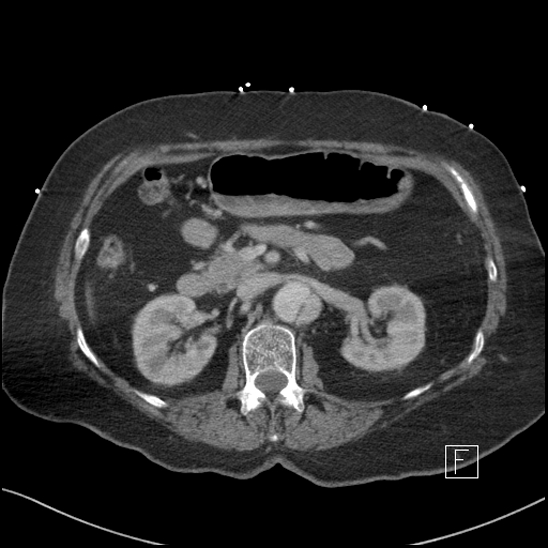 File:Aortic intramural hematoma with dissection and intramural blood pool (Radiopaedia 77373-89491 E 24).jpg