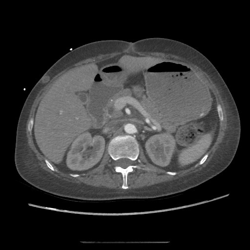 Aorto-duodenal fistula (Radiopaedia 25668-25850 A 18).jpg
