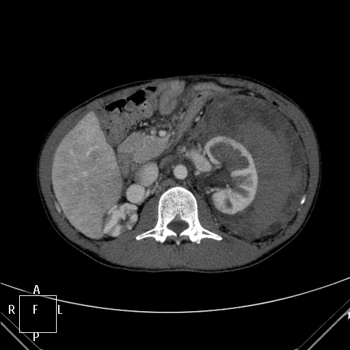 File:Aorto-left renal vein fistula (Radiopaedia 45534-49628 A 21).jpg
