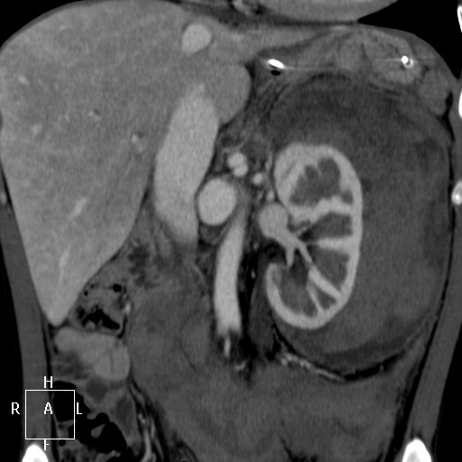 Aorto-left renal vein fistula (Radiopaedia 45534-49628 B 29).jpg