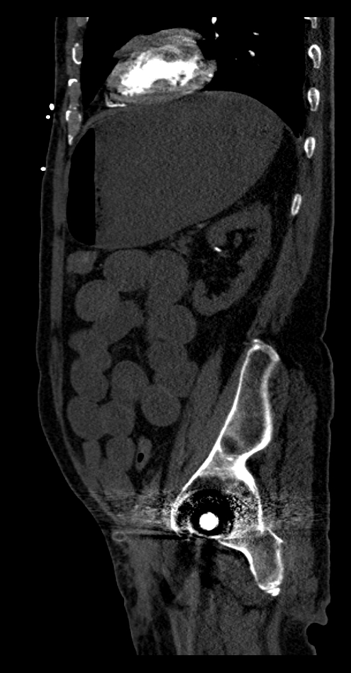 Aortoduodenal fistula (Radiopaedia 75286-86415 F 4).jpg