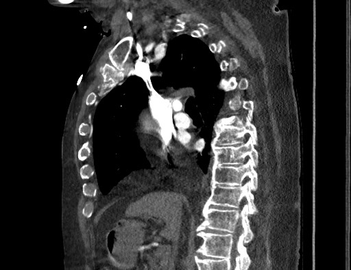Aortoesophageal fistula with endovascular repair (Radiopaedia 73781-84592 Sagittal C+ CTPA 83).jpg