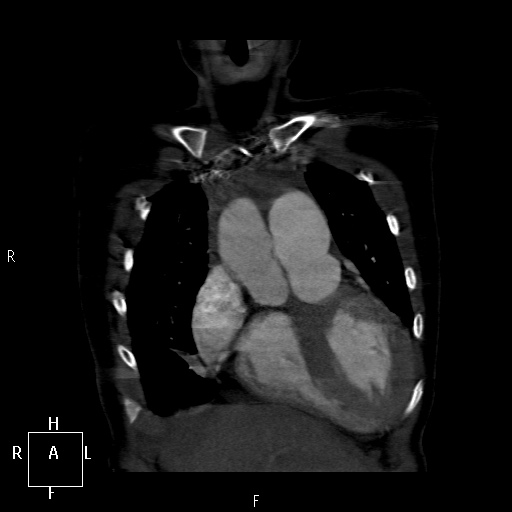 File:Aortopulmonary septal defect (Radiopaedia 41990-45013 Coronal C+ CTPA 9).jpg
