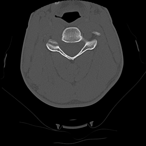 Apical pneumothorax on cervical spine CT (Radiopaedia 45343-49368 Axial bone window 44).jpg