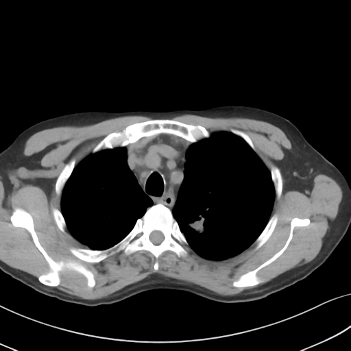 Apical pulmonary metastasis (Radiopaedia 46338-50754 B 16).png