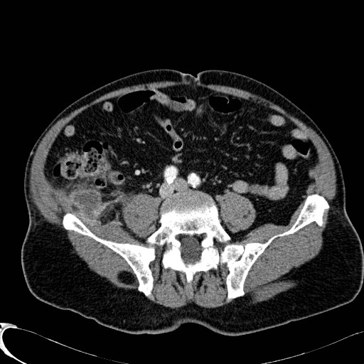 Appendiceal adenocarcinoma complicated by retroperitoneal abscess (Radiopaedia 58007-65039 B 92).jpg