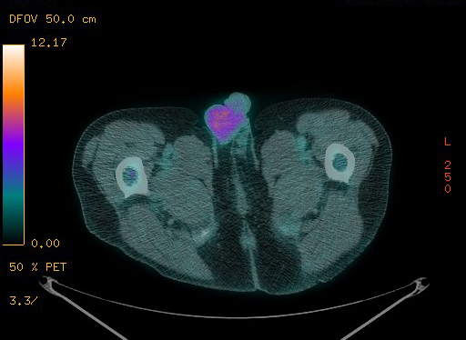 Appendiceal adenocarcinoma complicated by retroperitoneal abscess (Radiopaedia 58007-65041 Axial PET-CT 207).jpg