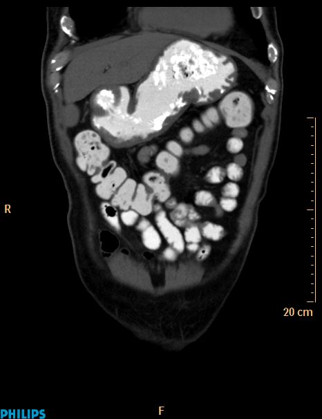 Appendiceal mucocoele (Radiopaedia 29449-29917 E 52).jpg