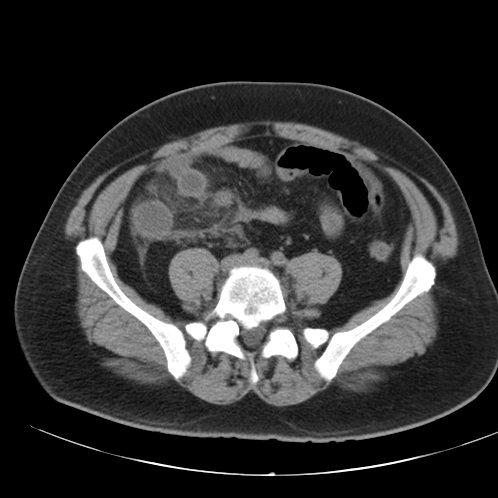 File:Appendicitis and giant appendicolith (Radiopaedia 80251-93588 Axial non-contrast 39).jpg